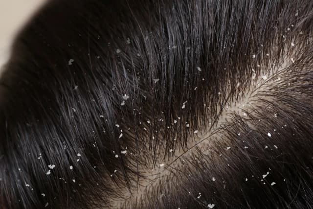 dandruff