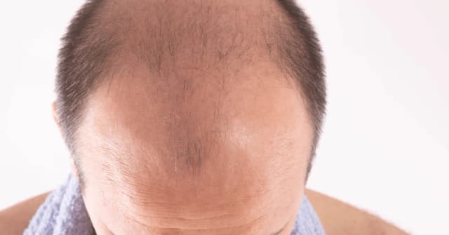 Baldness?