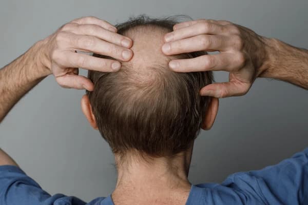 Hairfall?